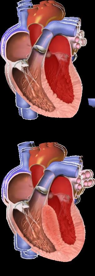 Hypertrophic cardiomyopathy