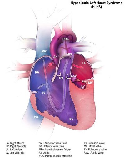 Hypoplastic Left Heart Syndrome