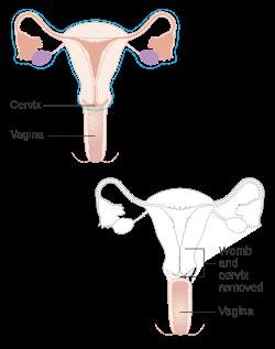 Hysterectomy