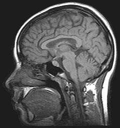 Idiopathic Intracranial Hypertension