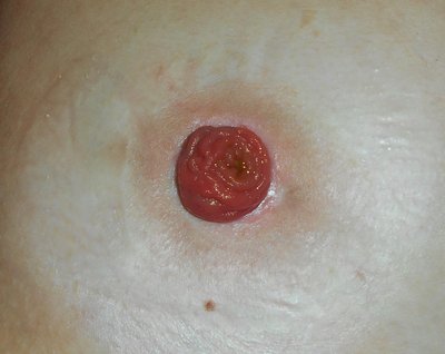 Ileostomy