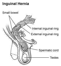 Inguinal Hernia