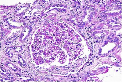Interstitial Nephritis