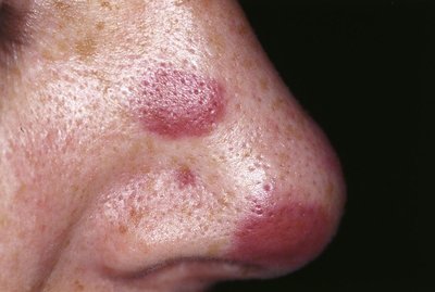 Kaposi's Sarcoma