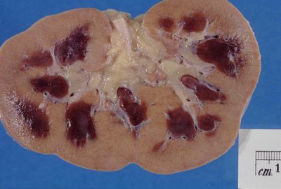 Kidney Disease
