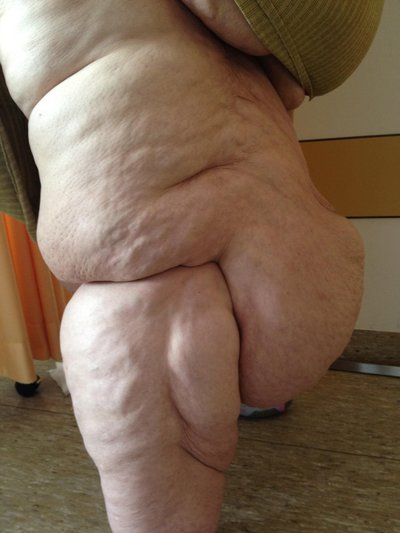 Lipedema