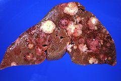Liver Disease