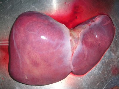 Liver Transplantation
