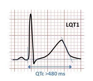 Long Qt Syndrome
