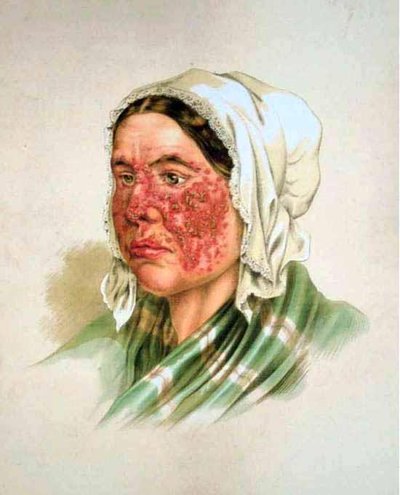 Lupus Erythematosus