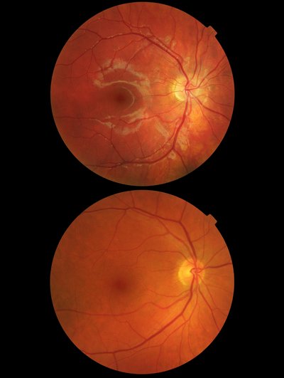 Macular Degeneration