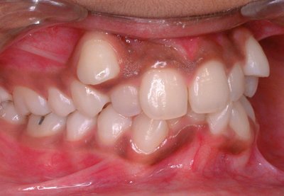 Malocclusion