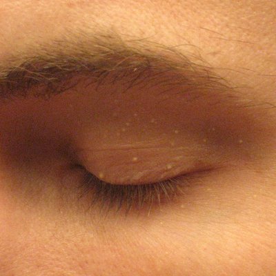 Milium (Dermatology)