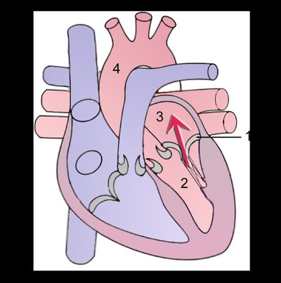 Mitral Insufficiency
