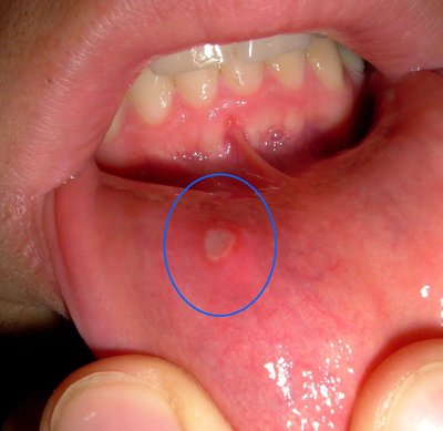 Mouth ulcer