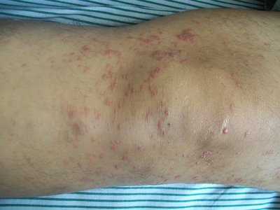 Mycosis Fungoides