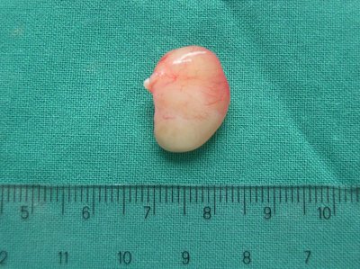Nasal polyp