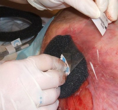 Negative-Pressure Wound Therapy