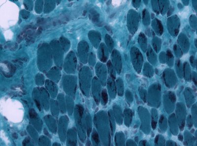 Neuromuscular Disease