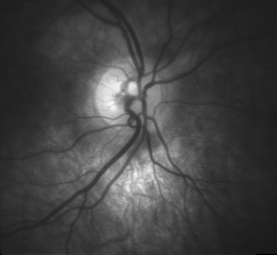 Optic Disc