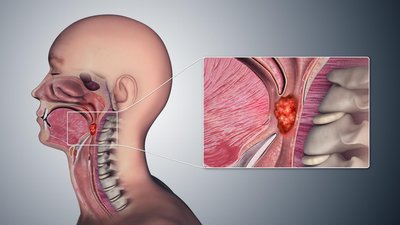 Oropharyngeal cancer