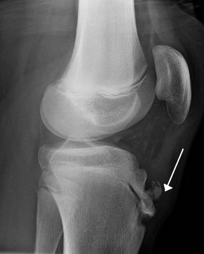 Osgood–Schlatter Disease
