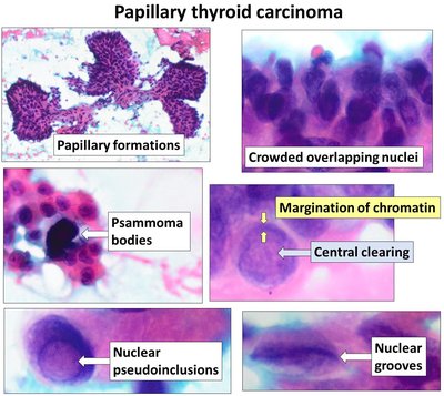 Papillary Thyroid Cancer