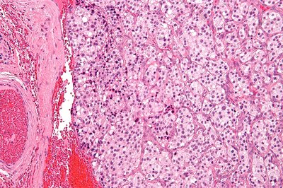 Paraganglioma