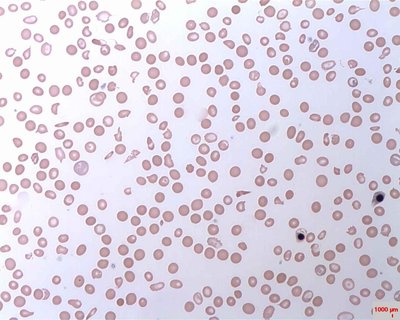 Paroxysmal Nocturnal Hemoglobinuria