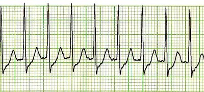Paroxysmal Supraventricular Tachycardia
