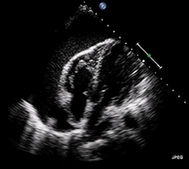 Pericardial Effusion