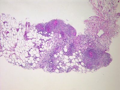 Peritonitis
