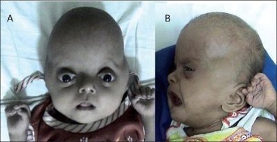 Pfeiffer Syndrome
