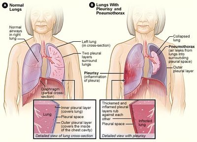 Pleurisy