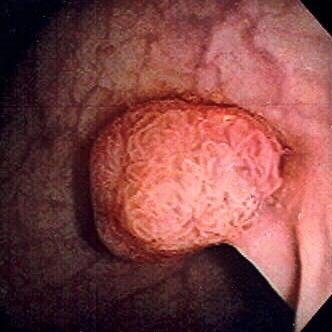 Polyp (medicine)