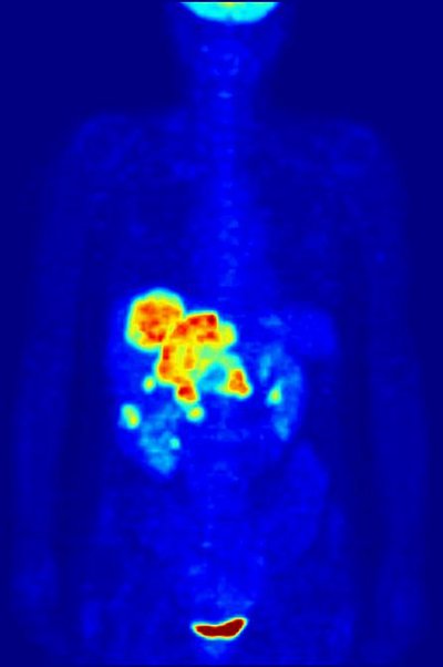 Positron Emission Tomography