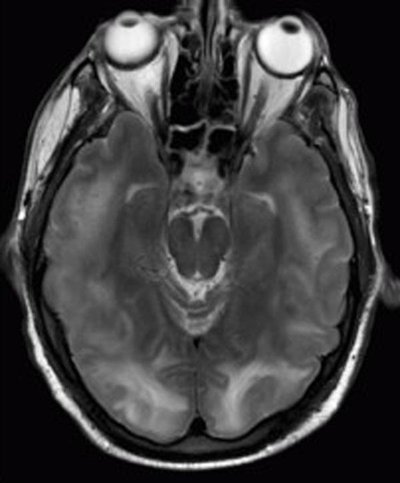 Posterior Reversible Encephalopathy Syndrome