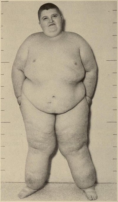 Prader–Willi syndrome