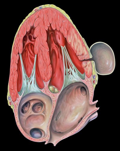 Pseudoaneurysm