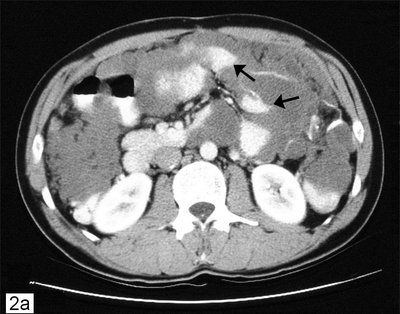 Pseudomyxoma Peritonei