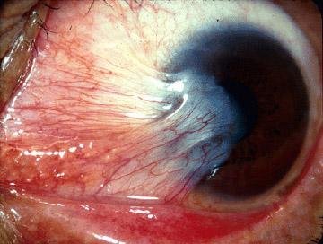 Pterygium (conjunctiva)