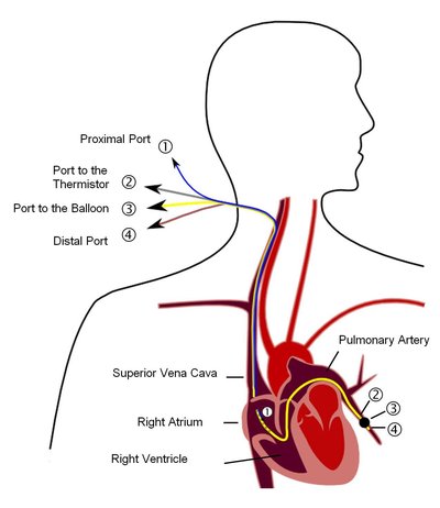 Pulmonary wedge pressure