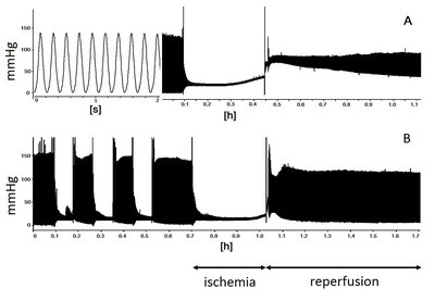 Reperfusion Injury