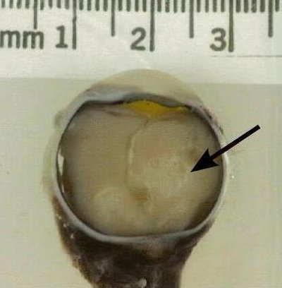 Retinoblastoma