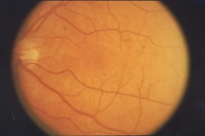 Retinopathy