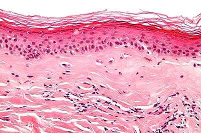 Sclerosis (Medicine)