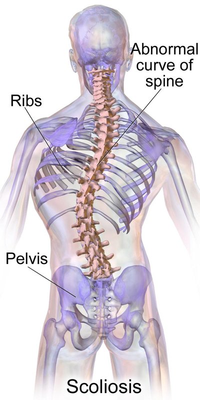 Scoliosis