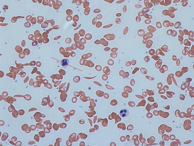Sickle Cell Trait