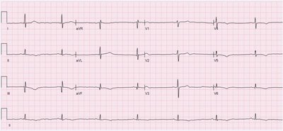 Sinus Bradycardia