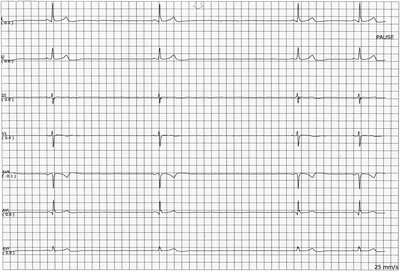 Sinus Node Dysfunction